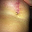 left vertical scar at 7 weeks