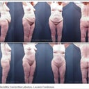 Abdominoplasty and liposuction of the back, abdomen and thighs. Thigh lift and skin removal.
