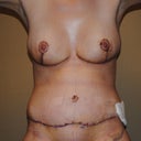 10 days post-op
