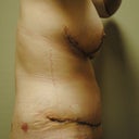 10 days post-op