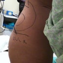 My back "non-contour" before surgery