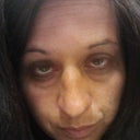 Night of the brake...  On top of the brake there was a huge goose egg on my lower forehead.  You can't see it as well here.  Excuse the eye makeup smudged.  It makes everything look 10 x worse