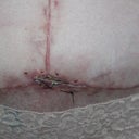 PO 6 weeks 1 day - It was stitched one week ago and the doctor wants them to stay in for 1 month.