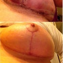 Left breast at 3 days and 30 days post op!  Wow, what a difference!!