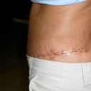 high scar on hips