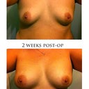 before/after views pre-op and 2 weeks post