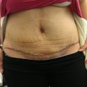 PO Day 11. Went in for tape change and got to see incision for first time.