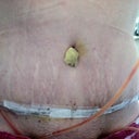Look at the stretch marks :(