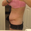 This was between 4-5 weeks. Much rounder than pre-op and getting rounder all the time.