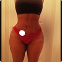 Front 7 months post -op