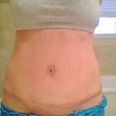 Low scar..fading away..all in time