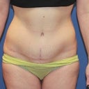 Weight Loss Reconstruction Of Abdomen And Thighs
