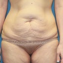 Weight Loss Reconstruction Of Abdomen And Thighs