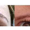 Before rejuvi, after rejuvi! One treatment, two months later.