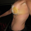 LEFT SIDE, DAY 5 POST OP