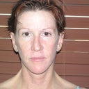 Front view, after