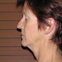 Side view, before