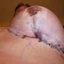 Post op day 1--lefty