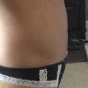 2 months post procedure.  This left side is flatter than the right side.