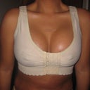 Breast Aug - Post Op