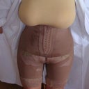 Front view 24 hrs post op
