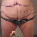 I'm going to be really happy if my insicsion is really as low as the markings. My PS said it's totally doable because my c-section scar is low. Fingers crossed!
