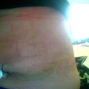 this was 2 days post op lots of swelling,but what a difference
