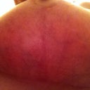 9 weeks Left T zone.  You can see scars are looking great and getting less red on them I think.  :)