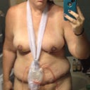 Day 2 post op