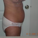 Abdomen before