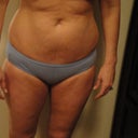Day Before Sugery