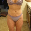 3 weeks post surgery/swelling on hips