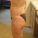 still some bruising 5 weeks later on R/L sides
