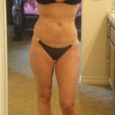 5 weeks post lipo