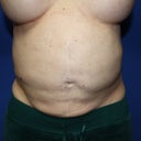 2 days preop