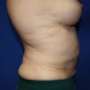 2 days preop