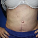 5 months post