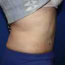 5 months post