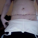 ! week post op