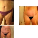Notice the difference in my legs.  Just an added bonus with TT surgery when your skin is lifted.