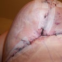 Post op day 1-- righty