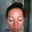 Day 3, leathery and tight spotty