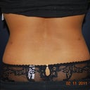 Back shot two months after lipo