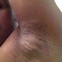 just after the procedure - left arm