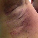 just after the procedure - right arm