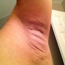 3 days later - left arm