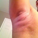 3 days later - right arm