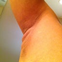 3 days later - right arm, side profile. to see the swollen pillowy affect