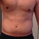 3 days later - swelling in the waist