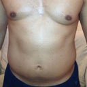 5 days later - severe swelling in torso/waist